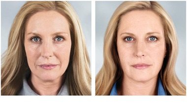 Facelift-Chirurgie