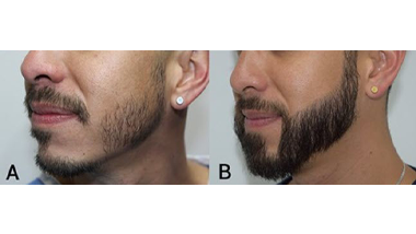 Beard Mustache Transplant 2024 Prices