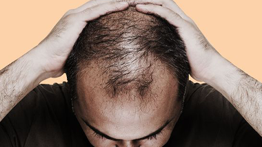 Saçlarımız Neden Dökülür, Tedavisi Nasıl Sağlanır